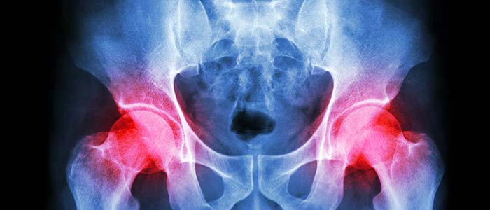 Chiropractic Dallas TX Hip Pain